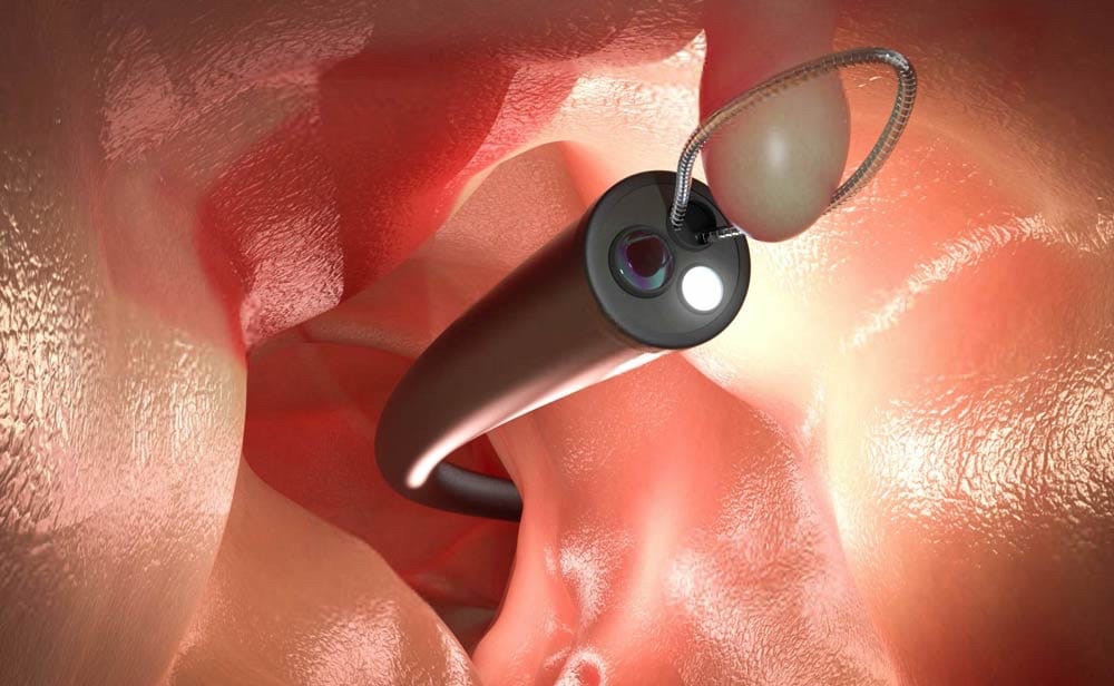 Ilustração de ressecção de um pólipo por endoscopia